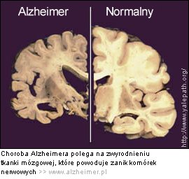 mózg_chory_i_mózg_zdrowy_w_chorobie_Alzheimera