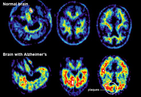 zdjęcia_tomografu_komputerowego_w_chorobie_Alzheimera
