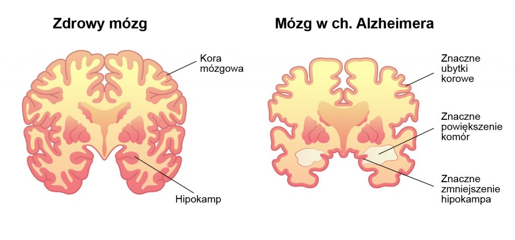 zdrowy_mózg_i_chory_mózg