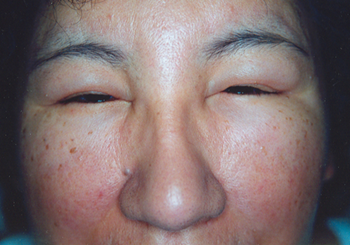 Obrzęk śluzowaty ( kiedyś choroba Gulla) to objaw choroby tarczycy, zwykle Hashimoto. Zazwyczaj występuje jako obrzęk twarzy i powiek