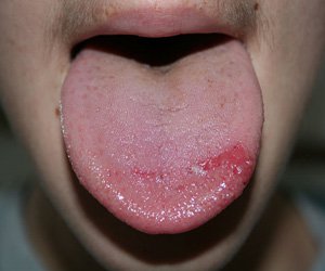Zzespół pieczenia jamy ustnej najczęsciej dotyczy języka, rzadziej podniebienia i gardła.