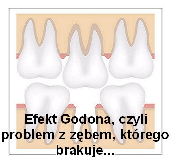 Efekt godona występuje, gdy brakuje jednego zęba. Łatwo jest taka wadę zignorować a brak nawet jednego zęba może mieć ogromny wływa na uzębienie