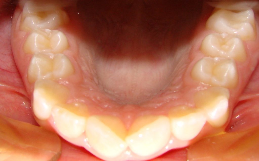stłoczenie wtórne- ma bardziej skomplikowany mechanizm. Powstaje wtedy, gdy zęby mleczne trzonowe (czwórki i piątki) zbyt wcześnie wypadną dziecku. Dochodzi do tego na skutek próchnicy gdy ząb taki trzeba usunąć. 
